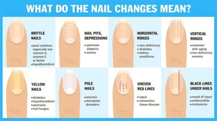 How to Treat Nail Ridges: A Comprehensive Guide to Healthy and Beautiful Nails
