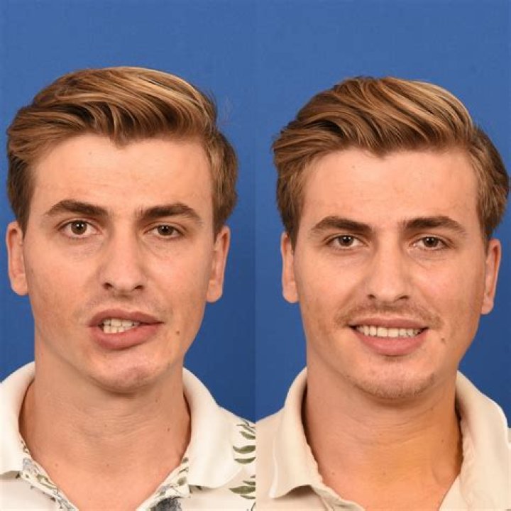 Male HGH Before and After Face: Transformations, Benefits, and Expert Insights